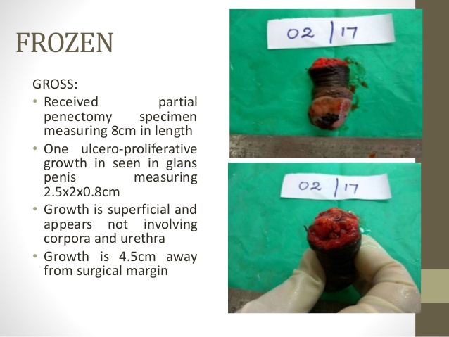 部分阴茎切除标本分析_02-2017
