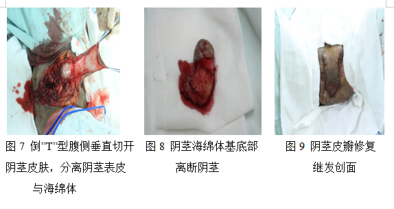 阳痿治疗手术病例分析图集