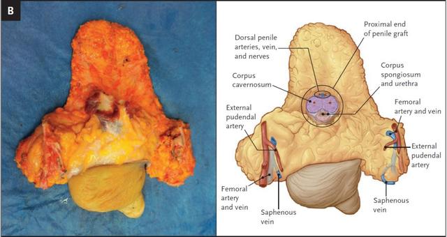 阴茎移植解剖图
